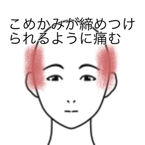 両側のこめかみが締めつけられるように痛む｜頭痛のツボ｜ツボネット 鍼灸の症例が検索できるツボ辞典