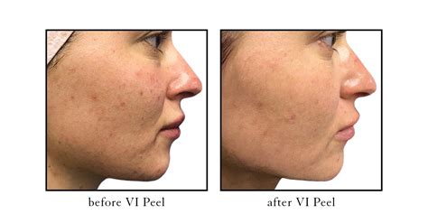 Laser Liposuction Filler Botox Before And After Pictures Cslc