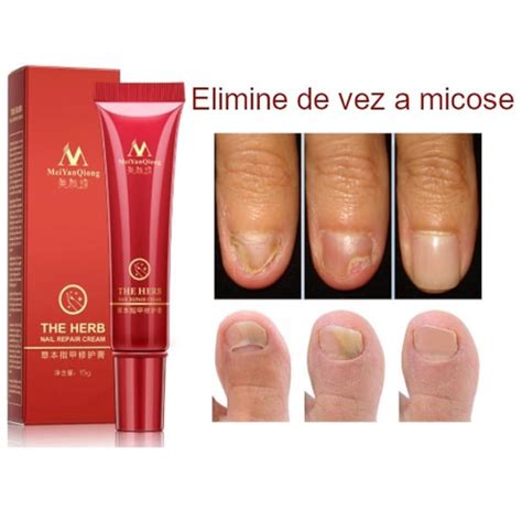 Melhor Antifungico Para Unhas Fungos Uso Dom Stico Em Promo O