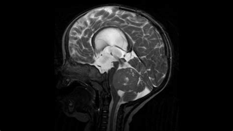 Medulloblastoma: Symptoms, Causes and Treatment | 2024