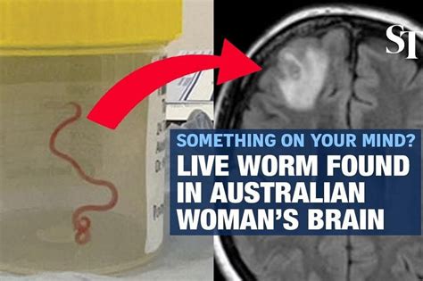 Alive And Wriggling Live Worm Found In Womans Brain In Australia