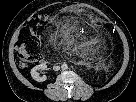 Retroperitoneal Leiomyosarcoma From The Radiologic Pathology Archives