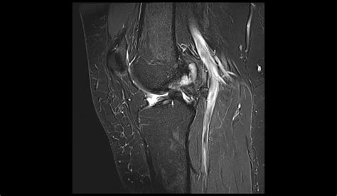 Anterior Cruciate Ligament Tear Mri Radiology Article On Acl Tear