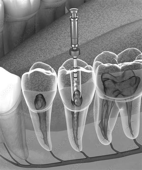 Endodontie Wurzelbehandlung Zahnarztpraxis Dr Benz Und Kollegen In