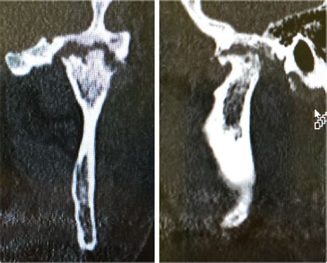 Coronal And Sagittal Reformats Of End Stage Tmj Djd Note The