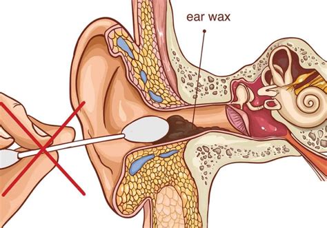 All About Ear Wax Removal Clear Ears Clinic