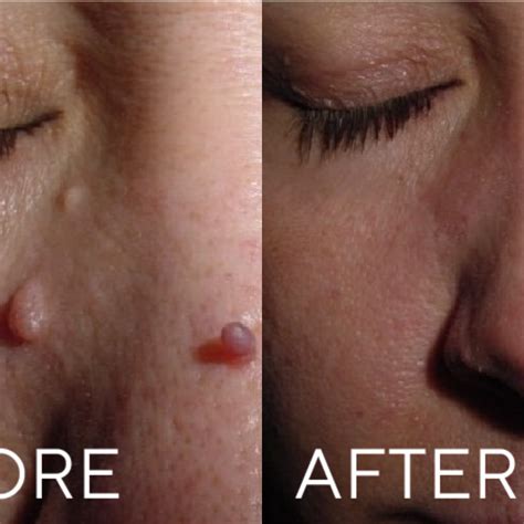 Cryopen Treatments In Lichfield Staffordshire Botox Dermal Fillers