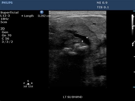 Submandibular Calculi And Sialadenitis Image Radiopaedia Org