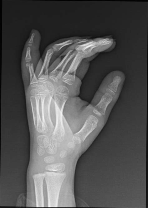 Fifth Finger Fracture Proximal Phalanx Image