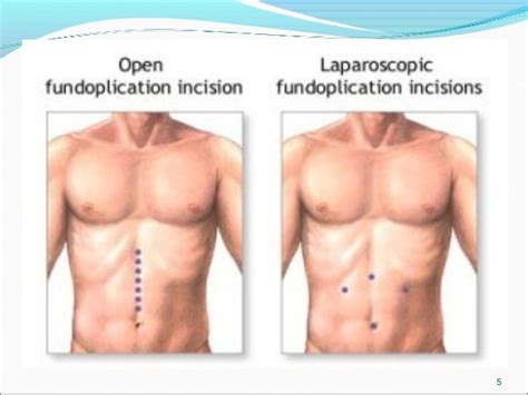 Fundoplication And Hellers Myotomy