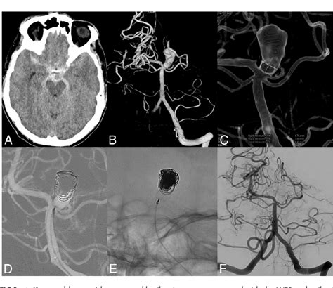 Figure 2 From Aneurysmsweb Treatment Of Ruptured Intracranial Semantic Scholar