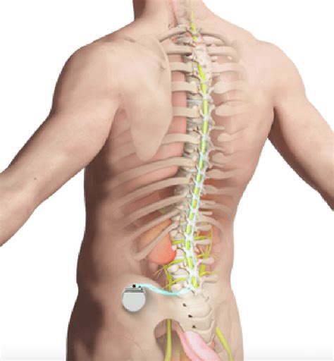 Spinal Cord Stimulator (SCS): Ripu Arora, MD, MBA: Board Certified Pain Management Anesthesiologist