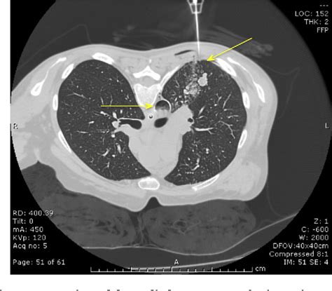 Figure 1 From Aortic Air Embolus Following Pulmonary Tumor