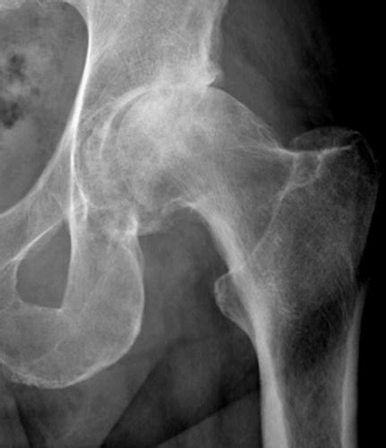 Hip Osteoarthritis Femoral Fractures And Total Hip Arthroplasty