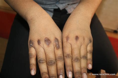 Acanthosis Nigricans Cured Case Homeo Energy