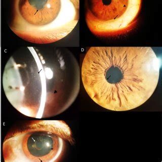 Clinical Photographs Of The Right Eye A And Left Eye Be Posterior