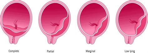 Types Of Placenta Previa Illustration John Yanson Oyelese Placenta