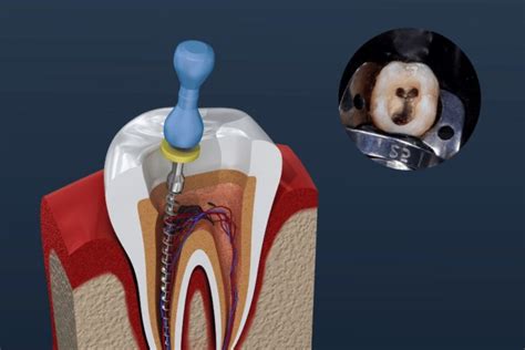 Root Canal Therapy Myths Vs Facts