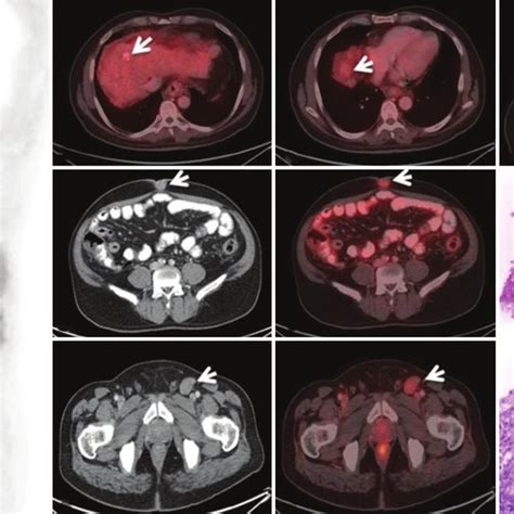 18f Fluorodeoxyglucose Fdg Positron Emission Tomography Computed