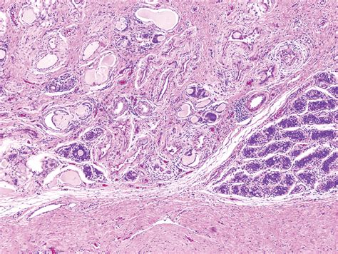 Epididymal Cyst Histology