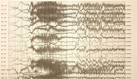 Electroencephalography (EEG) demonstrating migrating partial seizures ...