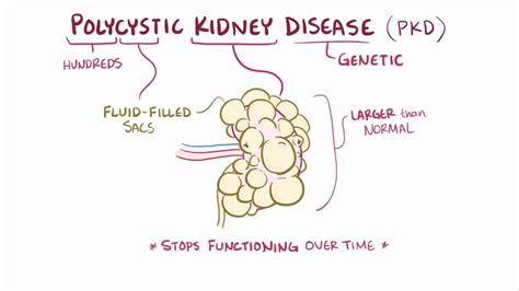 Polycystic kidney disease: Video, Anatomy & Definition | Osmosis