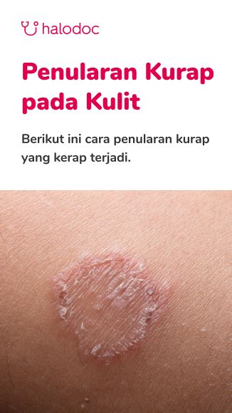 Kurap Adalah Ujian