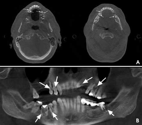 Figure From Multiple Idiopathic External And Internal Resorption