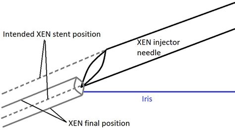 Learning Curve And One Year Outcome Of XEN 45 Gel Stent Implantation I