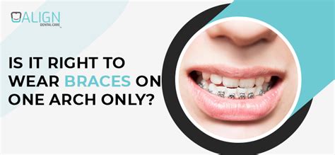 Single Arch Braces Single Arch Orthodontic Treatment