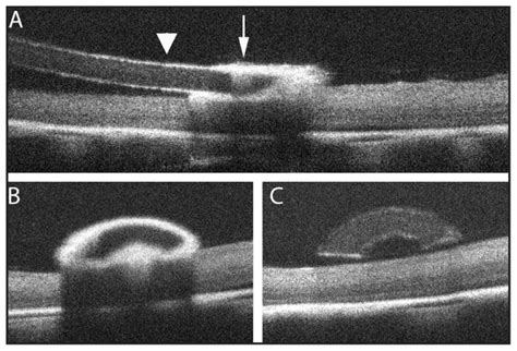 The use of optical coherence tomography in intraoperative ophthalmic ...