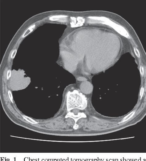 Biphasic Pulmonary Blastoma Semantic Scholar