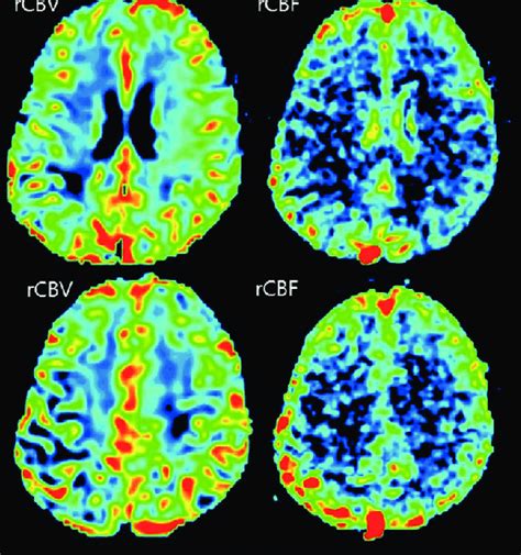 Mri Of Reversible Cerebral Vasoconstriction Syndrome In A 66 Year Old Download Scientific