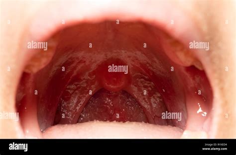 Sore Throat With Throat Swollen Closeup Open Mouth With Posterior