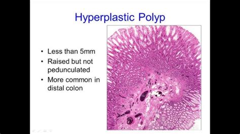 Sessile Serrated Adenoma Vs Hyperplastic Polyp