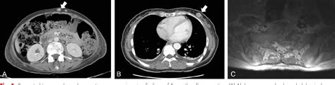 Figure 2 From Primary Signet Ring Cell Carcinoma Of The Uterine Cervix