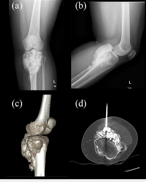 Preoperative Imaging Of The Patient A B Preoperative X Rays C 3d Download Scientific