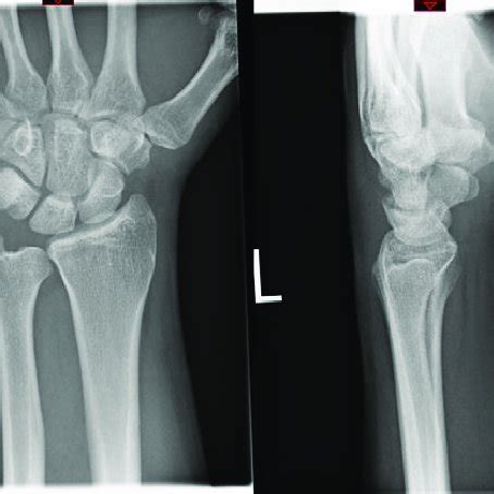 Lateral Radiography View Of The Left Wrist Showing The Anterior