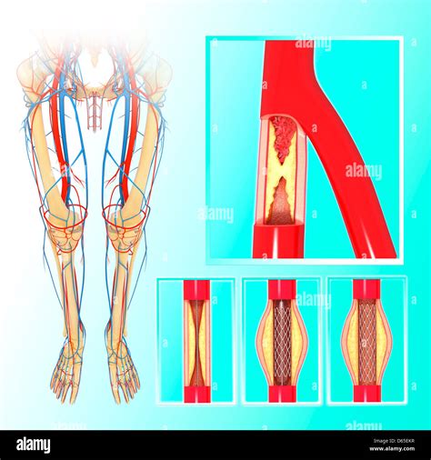 Angioplastie Der Beinarterie Fotos Und Bildmaterial In Hoher