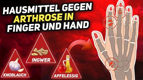 7 Natürliche Hausmittel gegen Arthrose in Finger und Hand YouTube