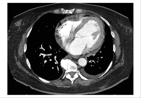 Axial Contrast Enhanced Computed Tomography Scan Demonstrates Small