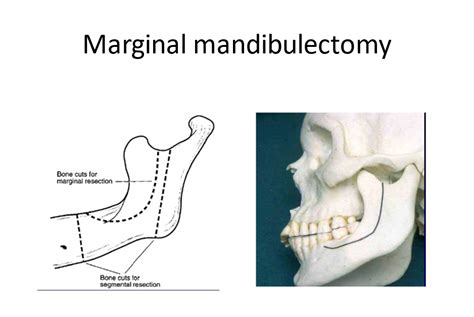 Jaw Bone Cancer - Symptoms, Causes and Treatment