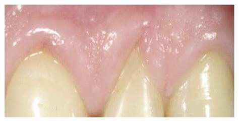 The Gingival Stillmans Clefts Histopathology And Cellular