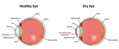 How To Cure Dry Eyes Permanently