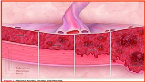 Diagramme Du Placenta Accreta