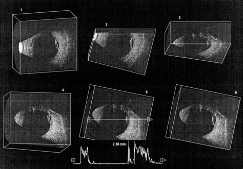 Three Dimensional Ultrasound For The Measurement Of Choroidal Melanomas