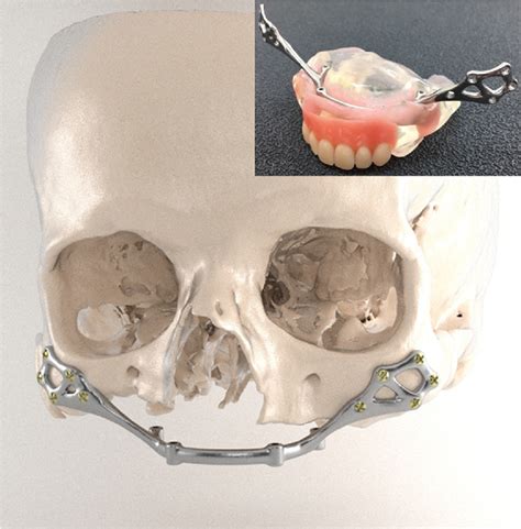 Patient Specific Sub Periosteal Zygoma Implant For Prosthetic