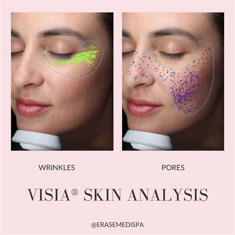 Visia Skin Analysis Lake Forest Il Skin Complexion Analysis