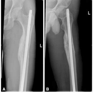 A B Followup A AP And B Lateral Radiographs Obtained At 48 Months