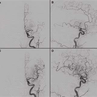 A And B Preoperative Cerebral Angiography Shows Left M1 Occlusion C